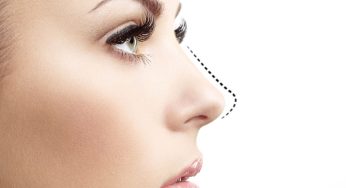 Botox Cuping Hidung makin Mancung dan Ideal