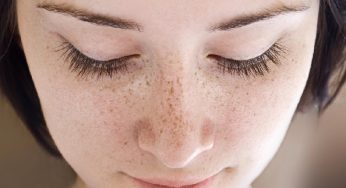 FLEk Hitam dan Bagaimana Cara Profesional menghilangkannya?