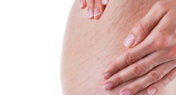 Stretch Marks pada Remaja – Penyebab dan Solusi