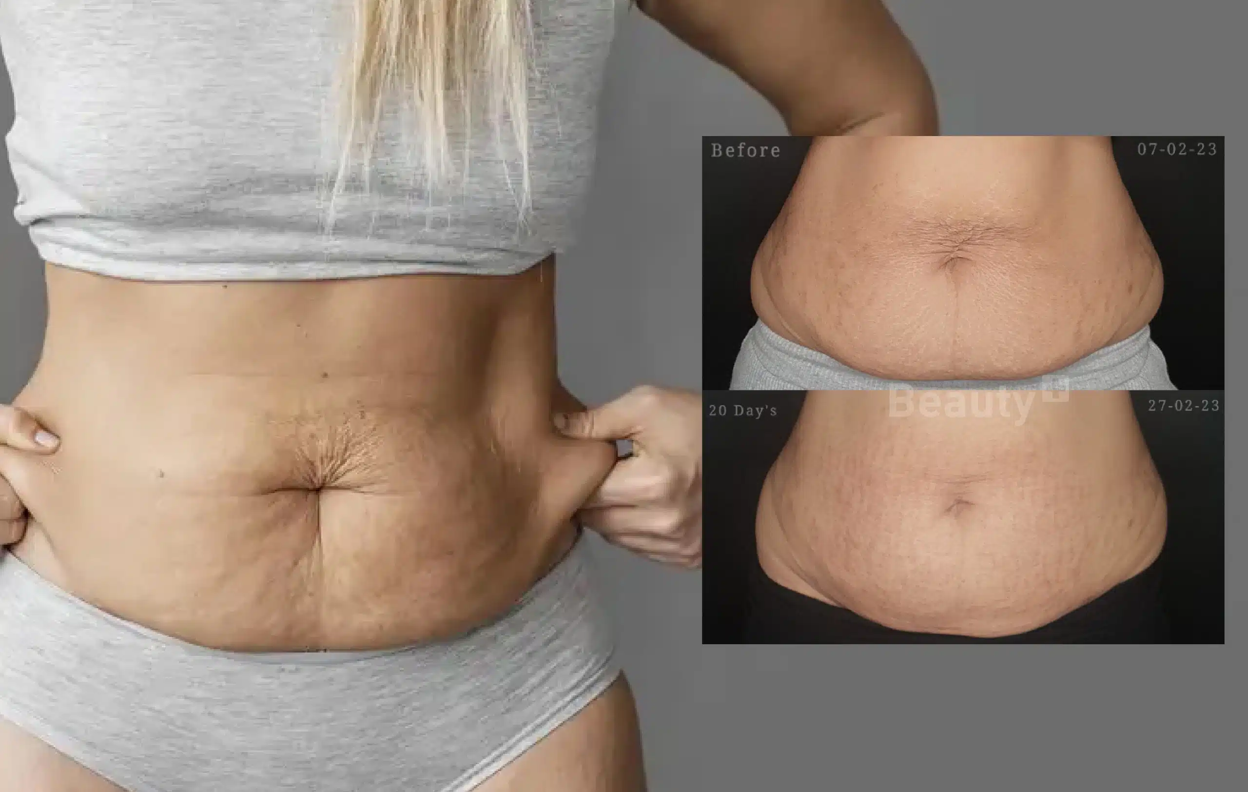 morpheus8 mengencangkan wajah kendur