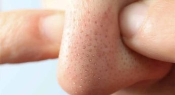 Treatment Facial Basic untuk Mengatasi Komedo