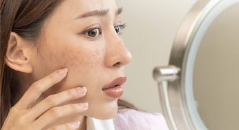 Harga Laser Wajah Flek Hitam: untuk Kulit Cerah dan Sehat