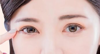 Cara Mengatasi Kelopak Mata Turun Sebelah Secara Alami