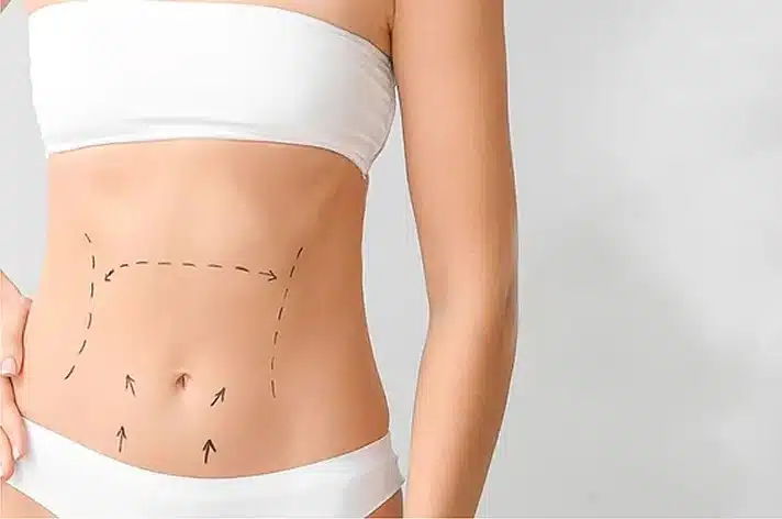 liposuction