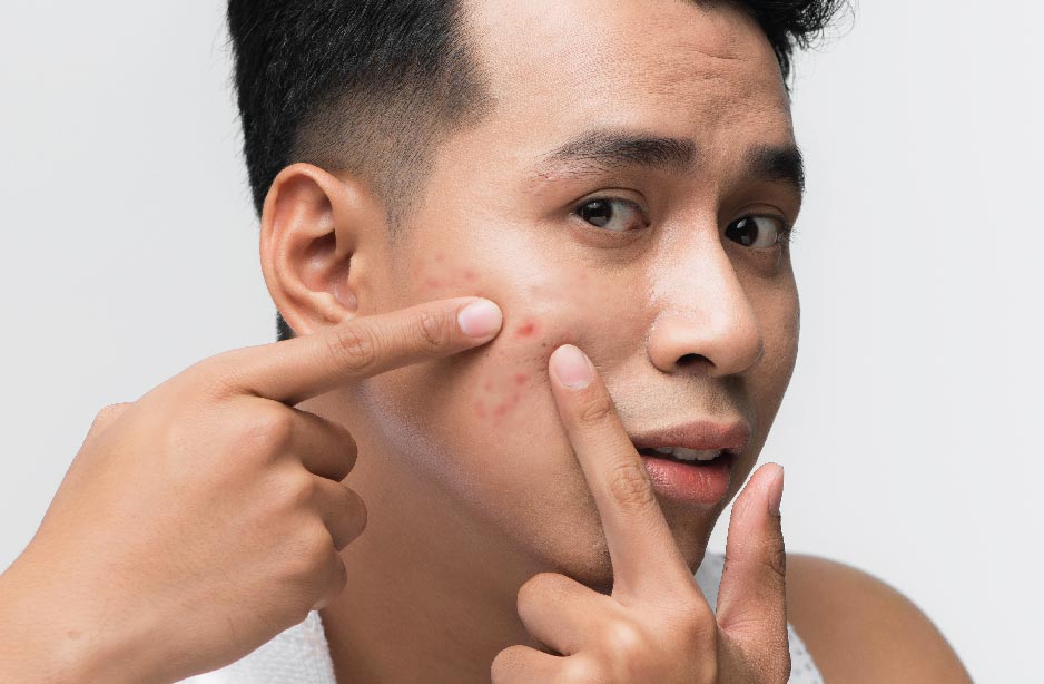 bye bye acne bye bye acne