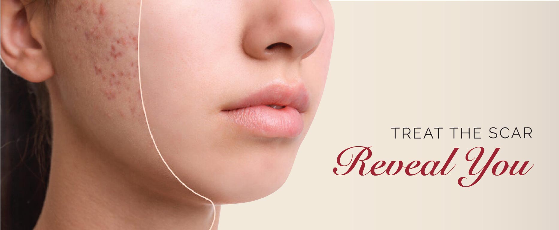 Scar Treatment Scar Treatment