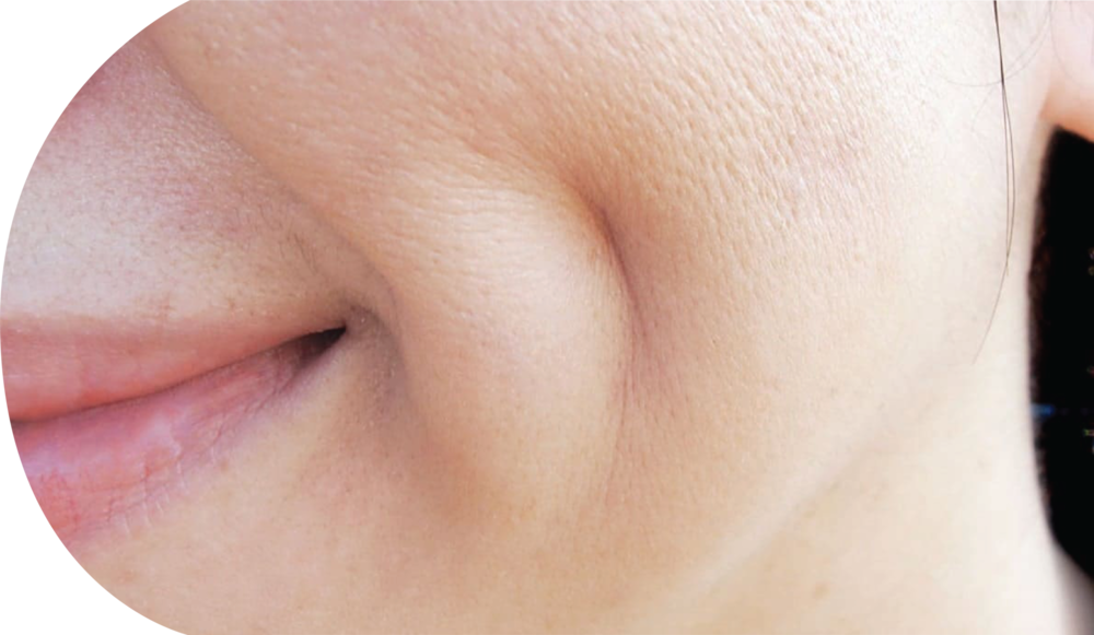 dimpleplasty (3) (1)